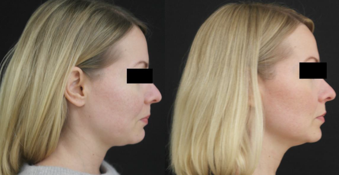 UltraLifted mid and lower face lifting results showing improved facial contour at Ponsarin Clinic Chiang Mai.