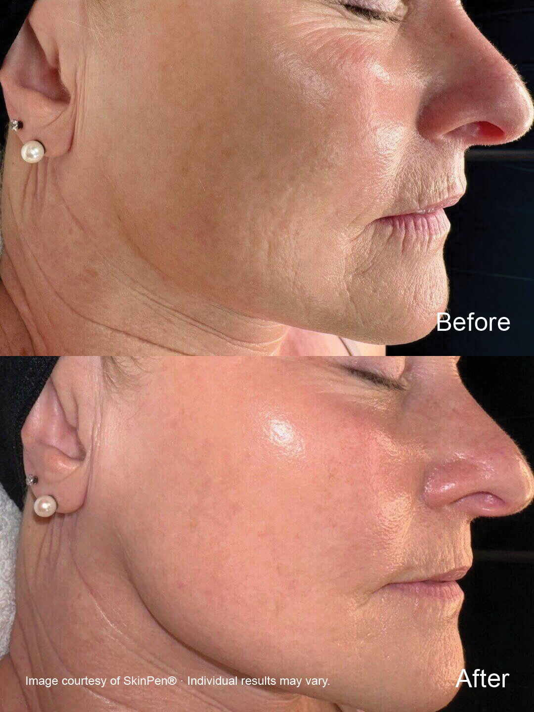 Before and after SkinPen microneedling showing improvement in the appearance of fine lines and skin texture.