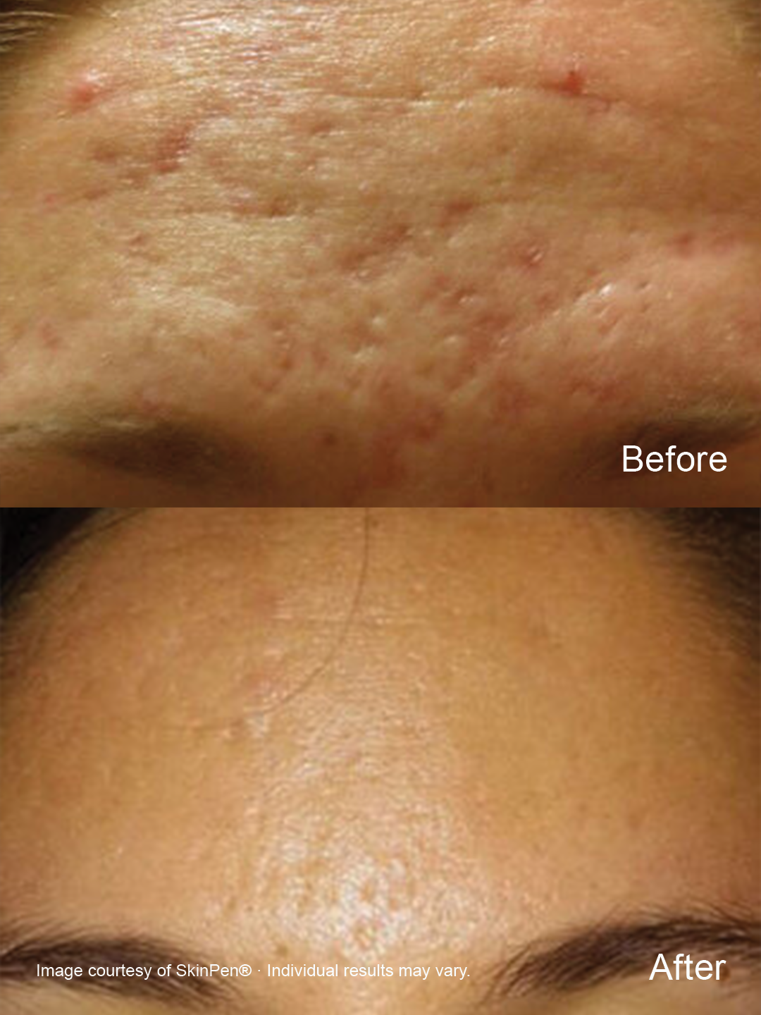 Before and after SkinPen microneedling showing improvement in the appearance of acne scars and uneven forehead texture.