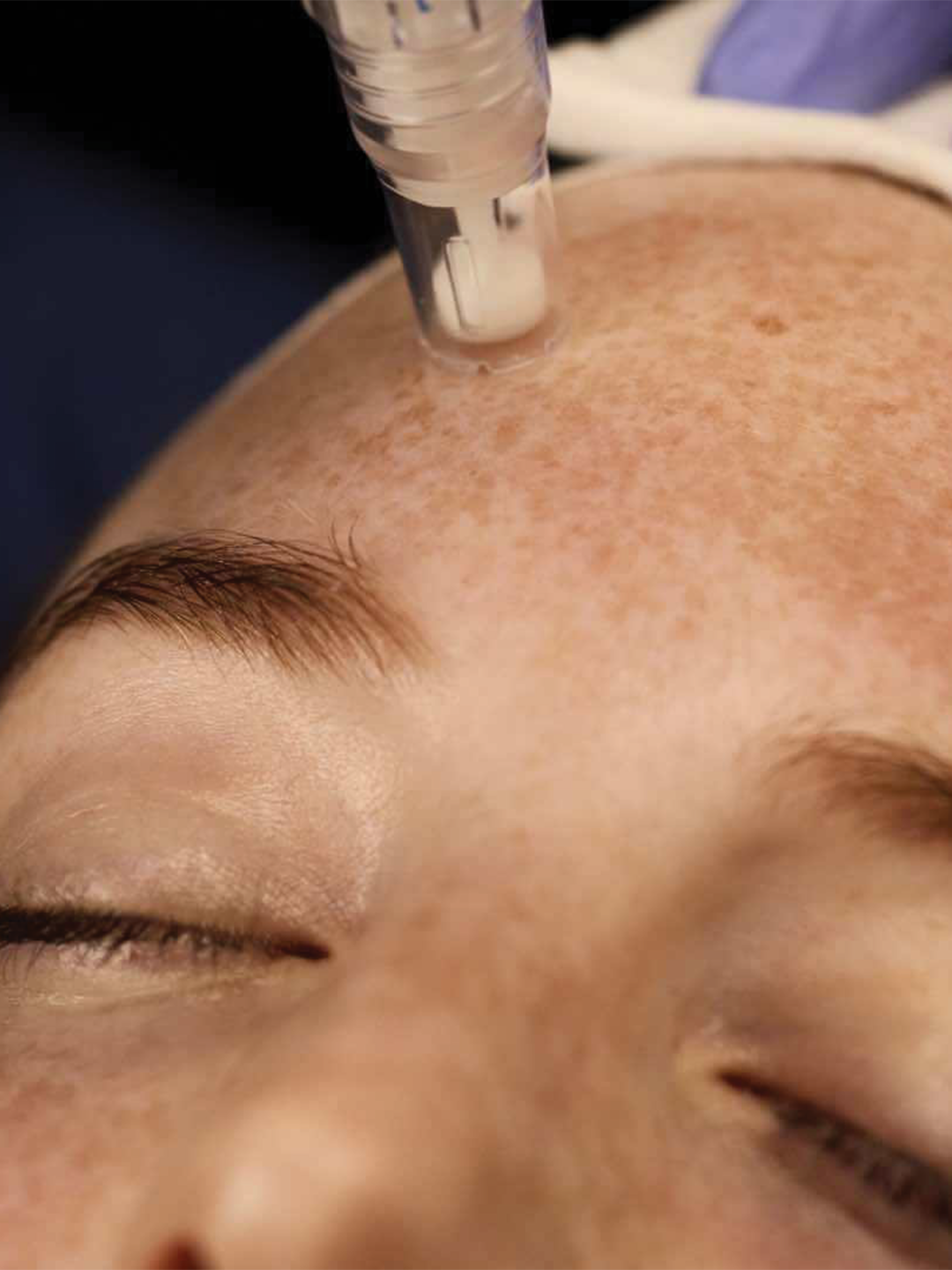 SkinPen microneedling treatment performed on the forehead.