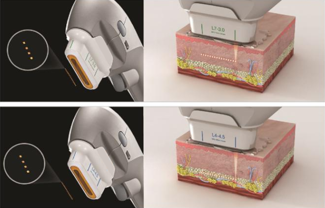 Diagram showing the UltraLifted device handpieces and cross-section illustrations of ultrasound energy targeting different skin depths, used at Ponsarin Clinic.