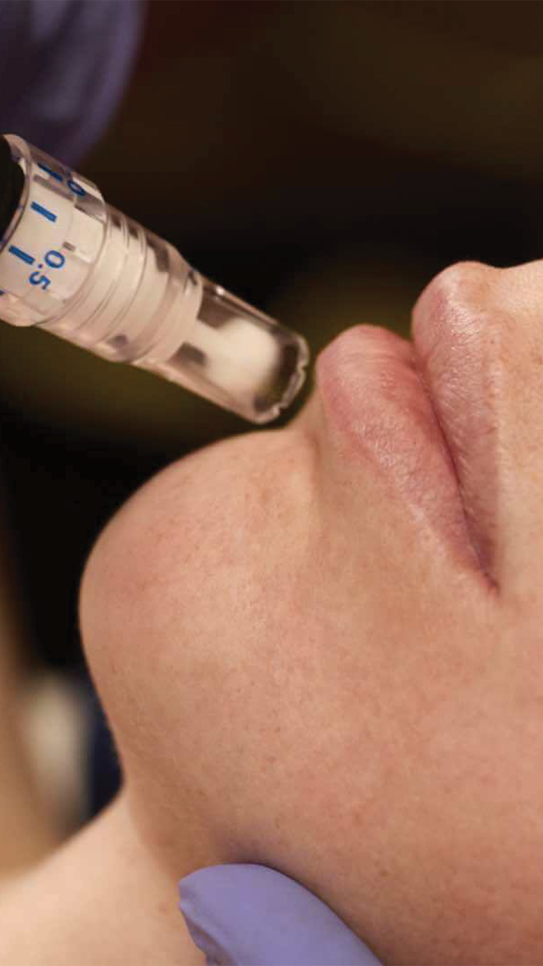 SkinPen® Face, Neck & Décolleté