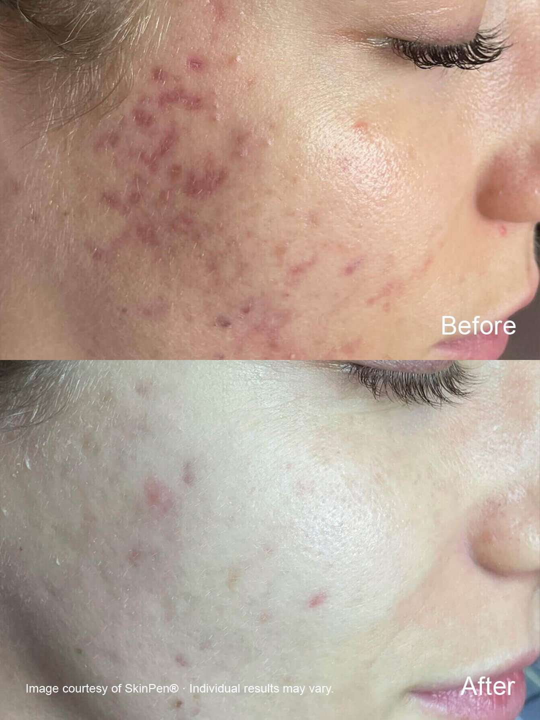 Before and after SkinPen microneedling showing improvement in the appearance of acne marks and uneven skin texture.