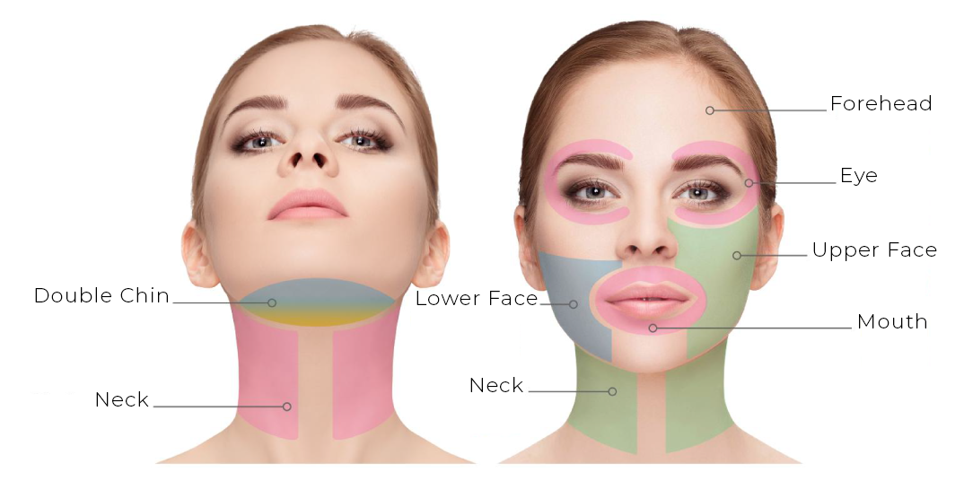 UltraLifted treatment areas for the forehead, eye area, mid and lower face, double chin and neck.