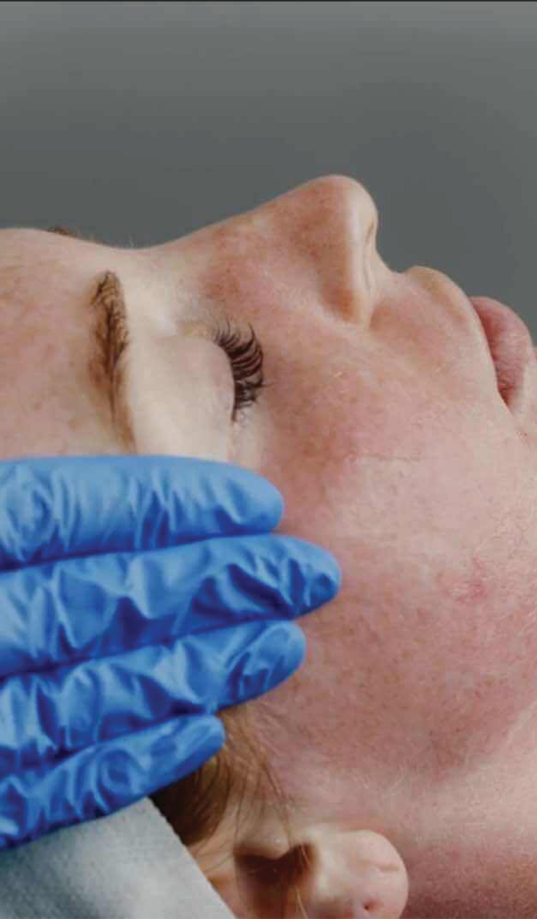 Mild facial redness immediately after SkinPen microneedling treatment.