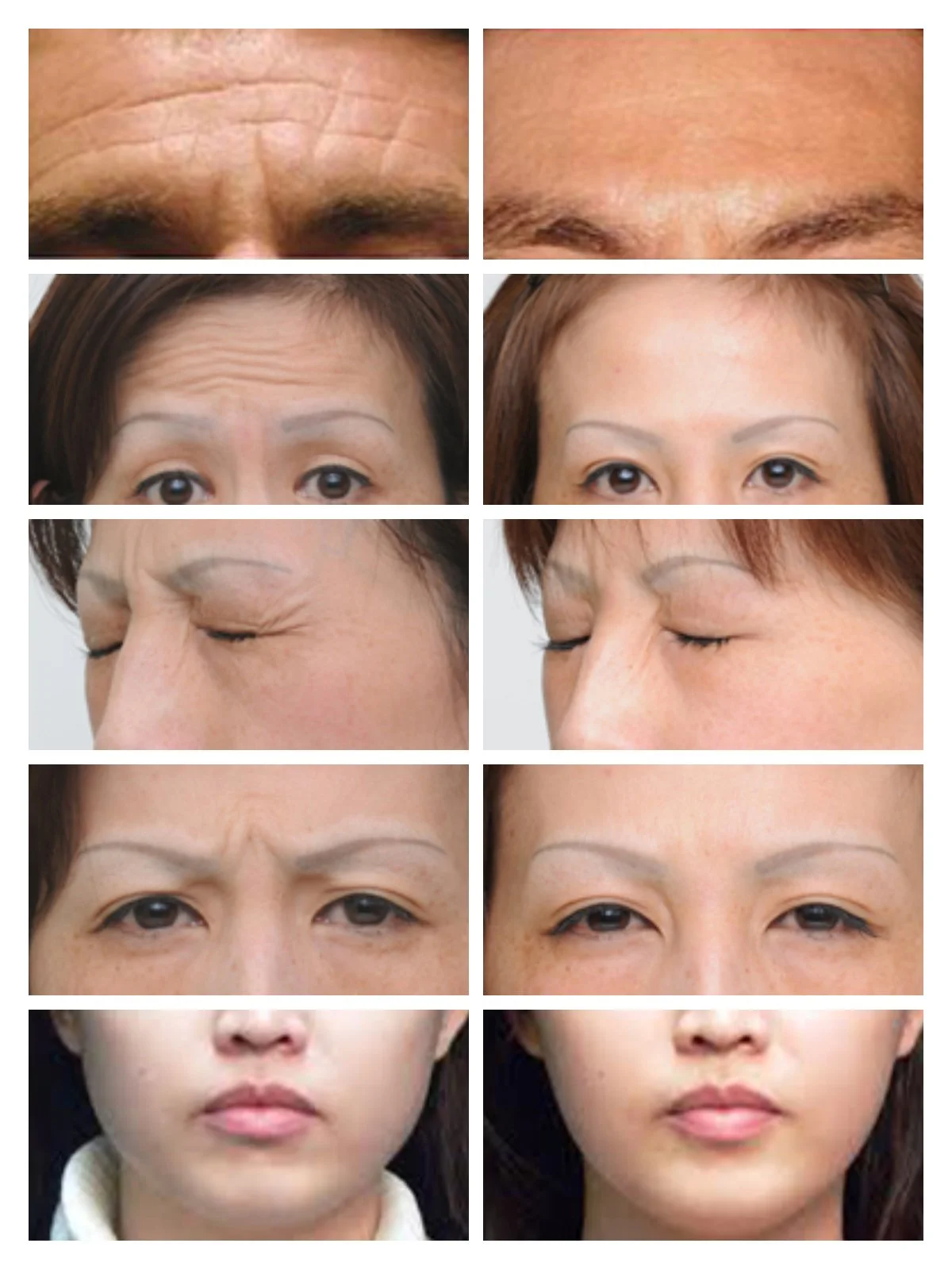 "Before-and-after comparison photos of a client's forehead and eye area showing smoother skin and reduced wrinkles following botox treatment at Ponsarin Clinic."