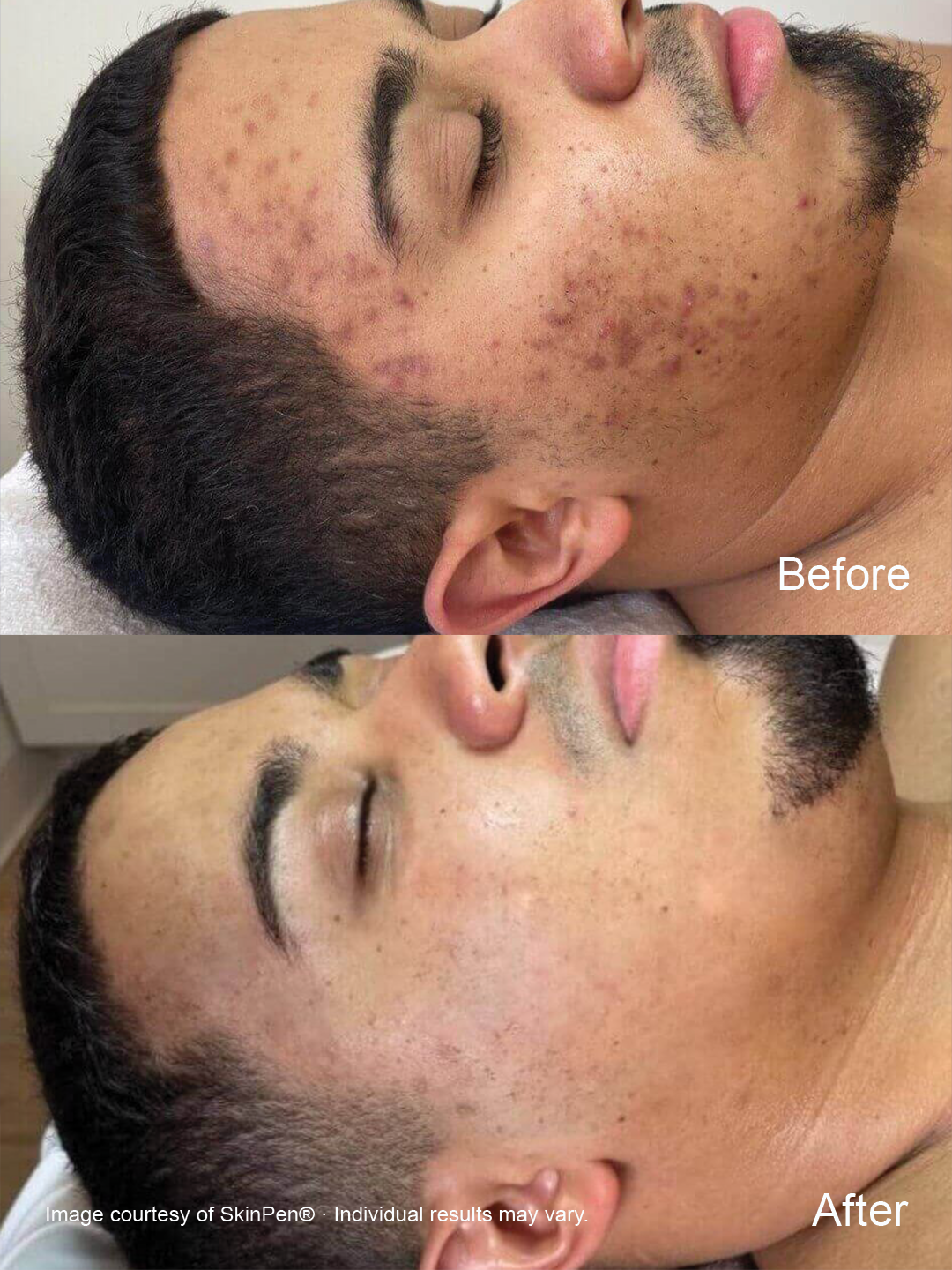 Before and after SkinPen microneedling showing improvement in the appearance of uneven skin tone and facial pigmentation.