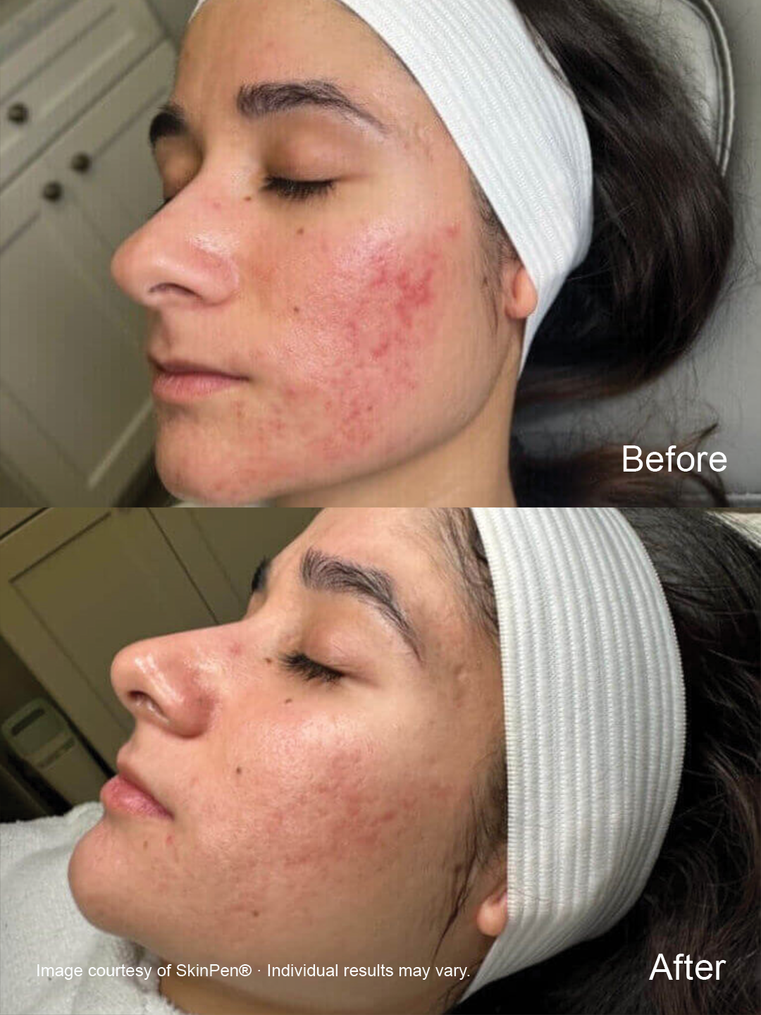 Before and after SkinPen microneedling showing improvement in the appearance of acne-related marks and uneven skin texture.