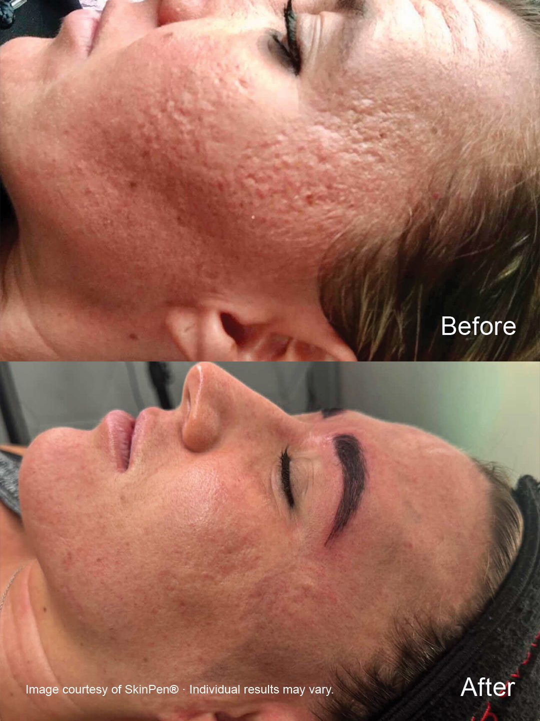 Before and after SkinPen microneedling showing improvement in facial skin texture and overall skin appearance.