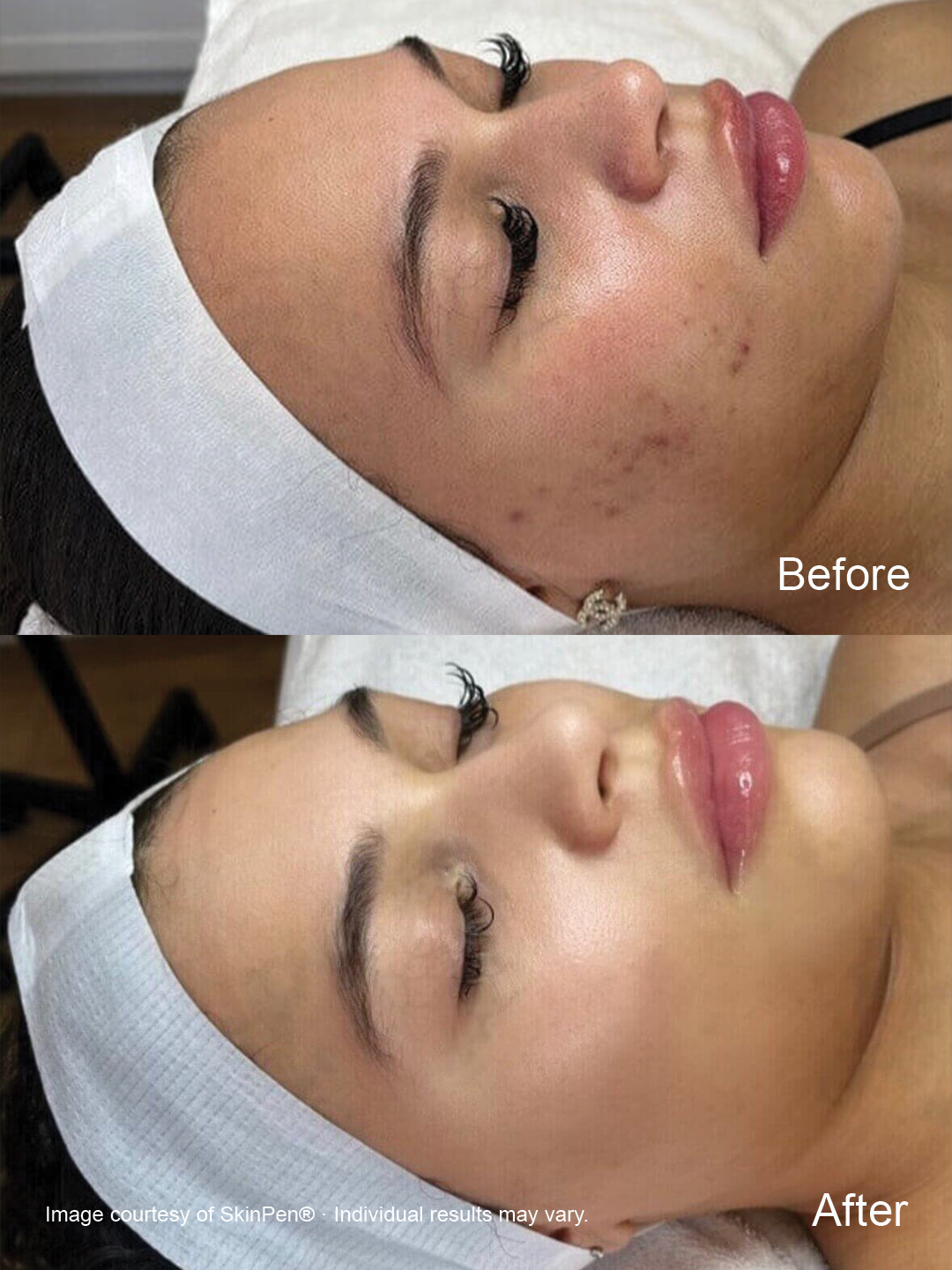Before and after SkinPen microneedling showing improvement in the appearance of uneven skin tone and facial skin texture..