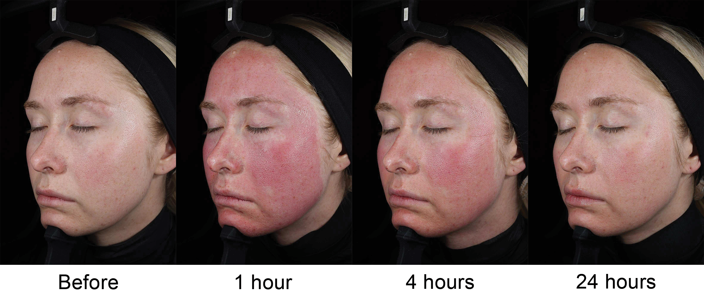 SkinPen microneedling redness and recovery shown before treatment and at 1, 4 and 24 hours after treatment.
