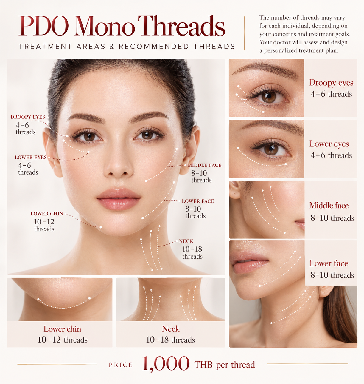 PDO Mono Thread treatment areas for the face, under-eye area, chin and neck, showing estimated thread quantities and pricing at Ponsarin Clinic in Chiang Mai