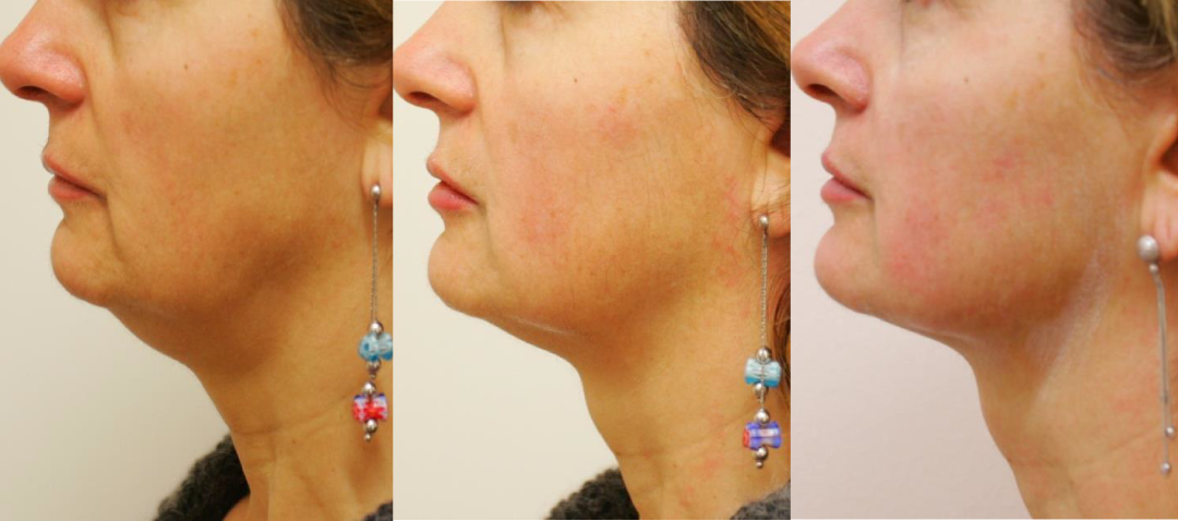 UltraLifted jawline and double chin tightening results at Ponsarin Clinic Chiang Mai.