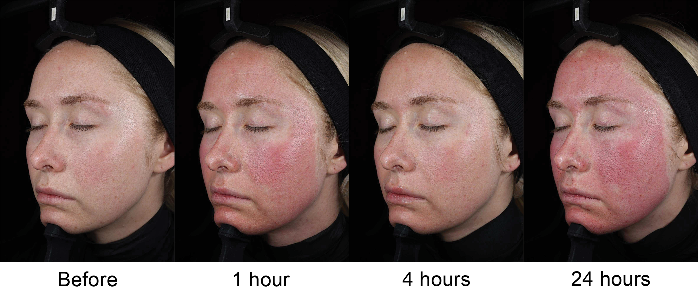 SkinPen microneedling redness and recovery shown before treatment and at 1, 4 and 24 hours after treatment.