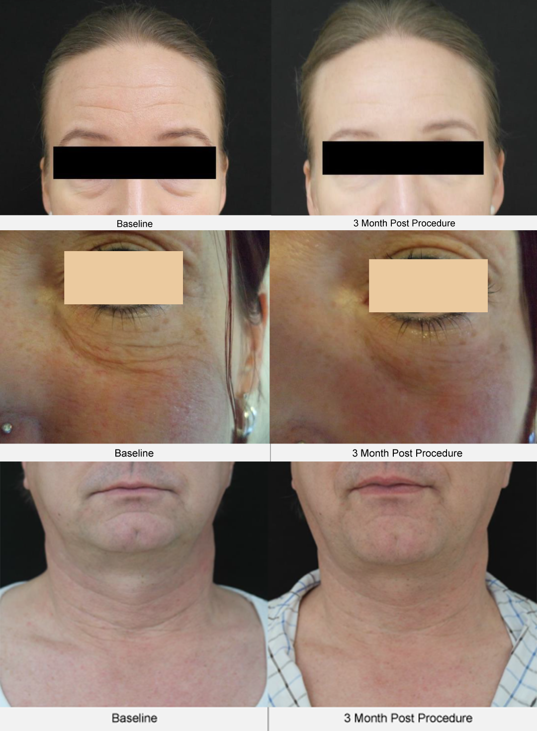 UltraLifted face and neck tightening results at 3 months showing improved skin firmness and facial contour.