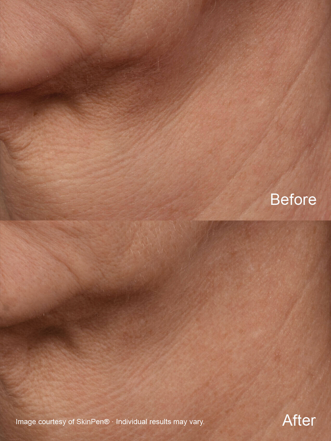 SkinPen® Precision Microneedling