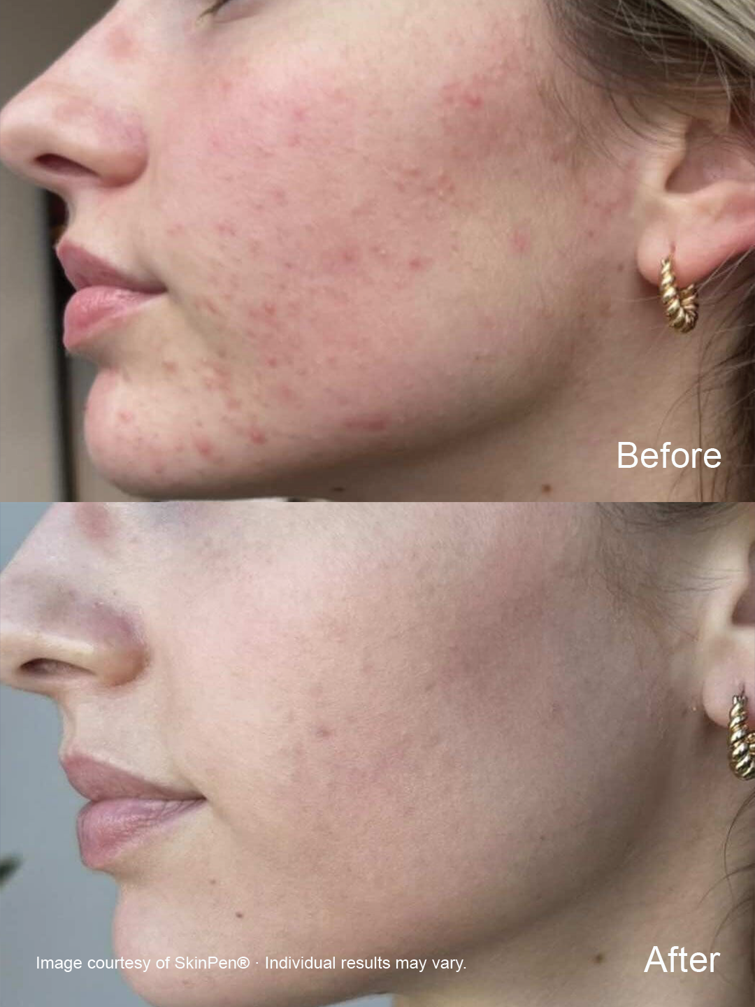 Before and after SkinPen microneedling showing improvement in the appearance of acne scars and uneven skin texture.