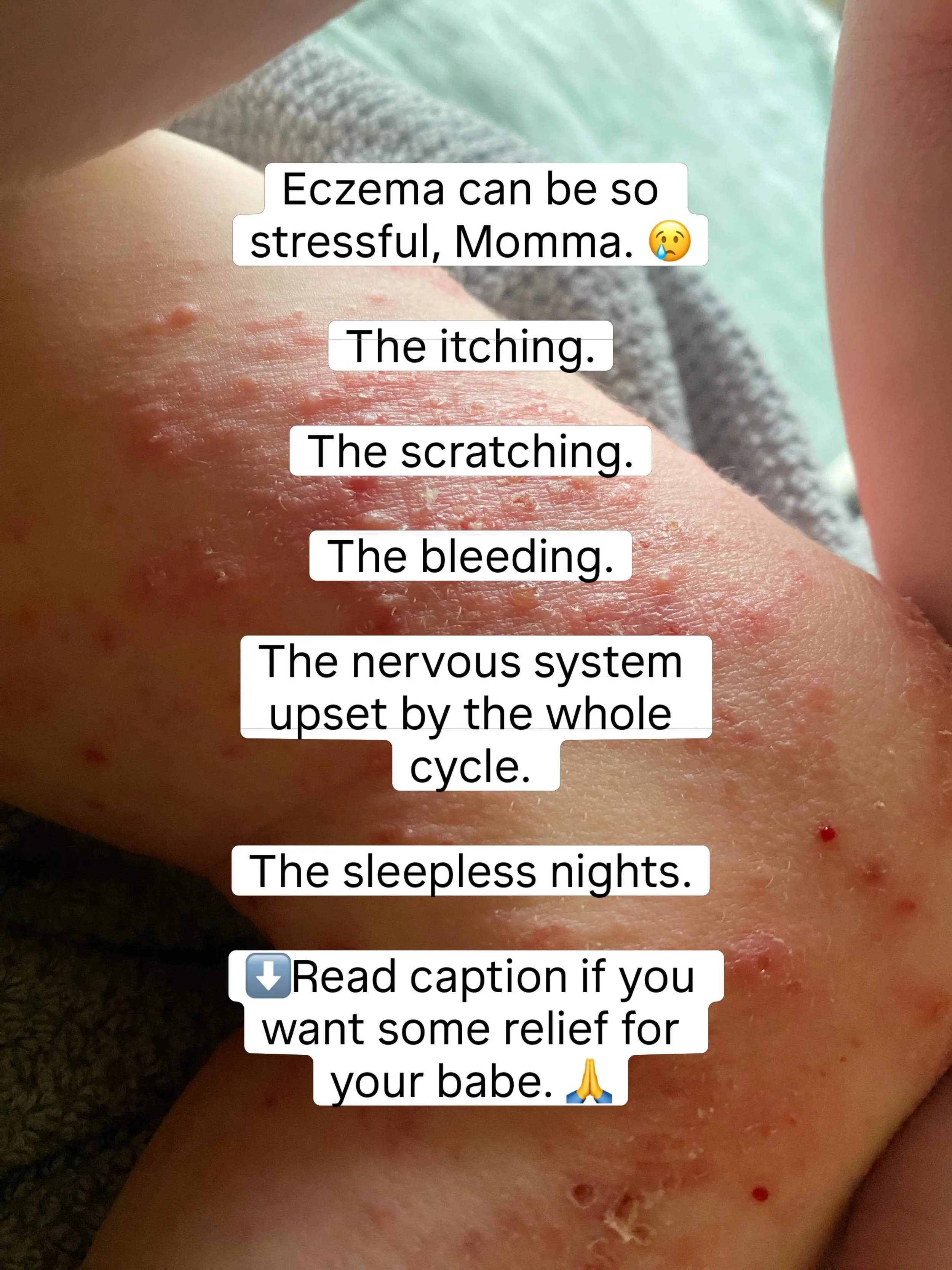 When my son was little we tried EVERYTHING to help stop the cycle of itching, bleeding, redness, and irritation. And nothing really seemed to make that much of a difference. 😭 It was years of stress and tears, and discouragement.😬

I was tired of t