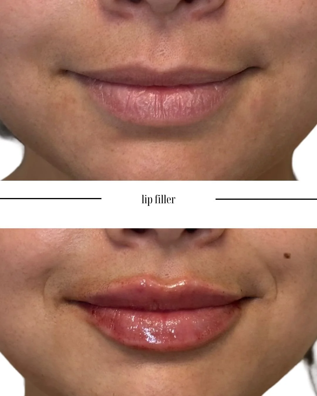Close-up of a person's lips before and after lip filler treatment, showing fuller and glossier lips in the after photo.