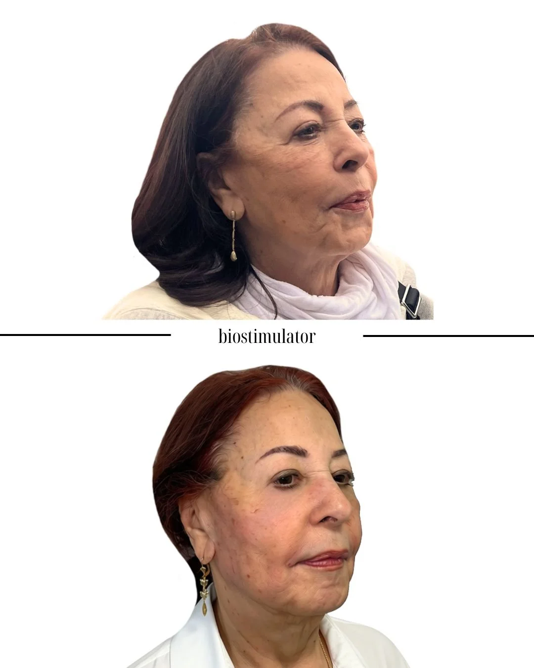 Comparison of a woman before and after biostimulator treatment showing improved skin texture and reduced wrinkles.