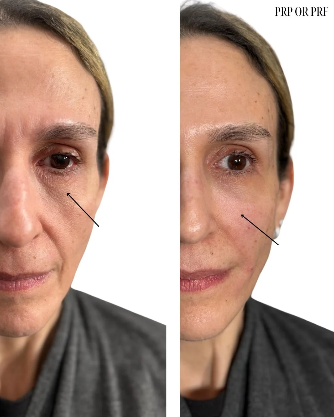 Comparison of a woman's face before and after PRP or PRF treatment, highlighting improvements in skin texture and appearance around the eye area.