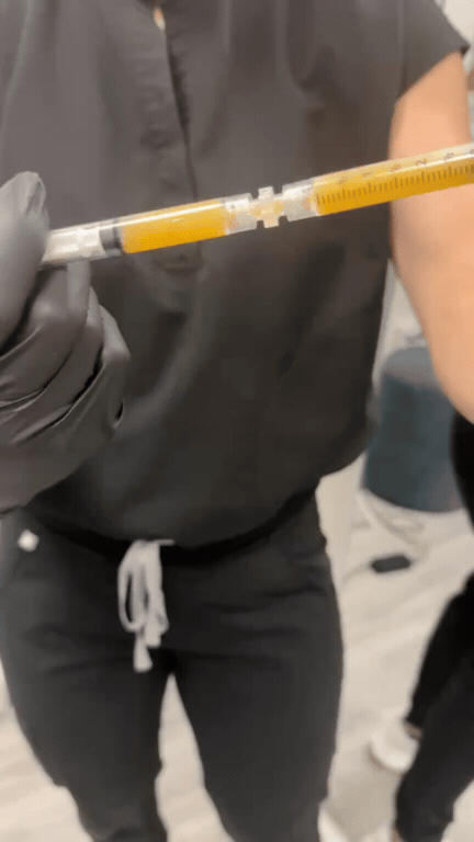 Your PRF/PRP treatment plan in Miami
