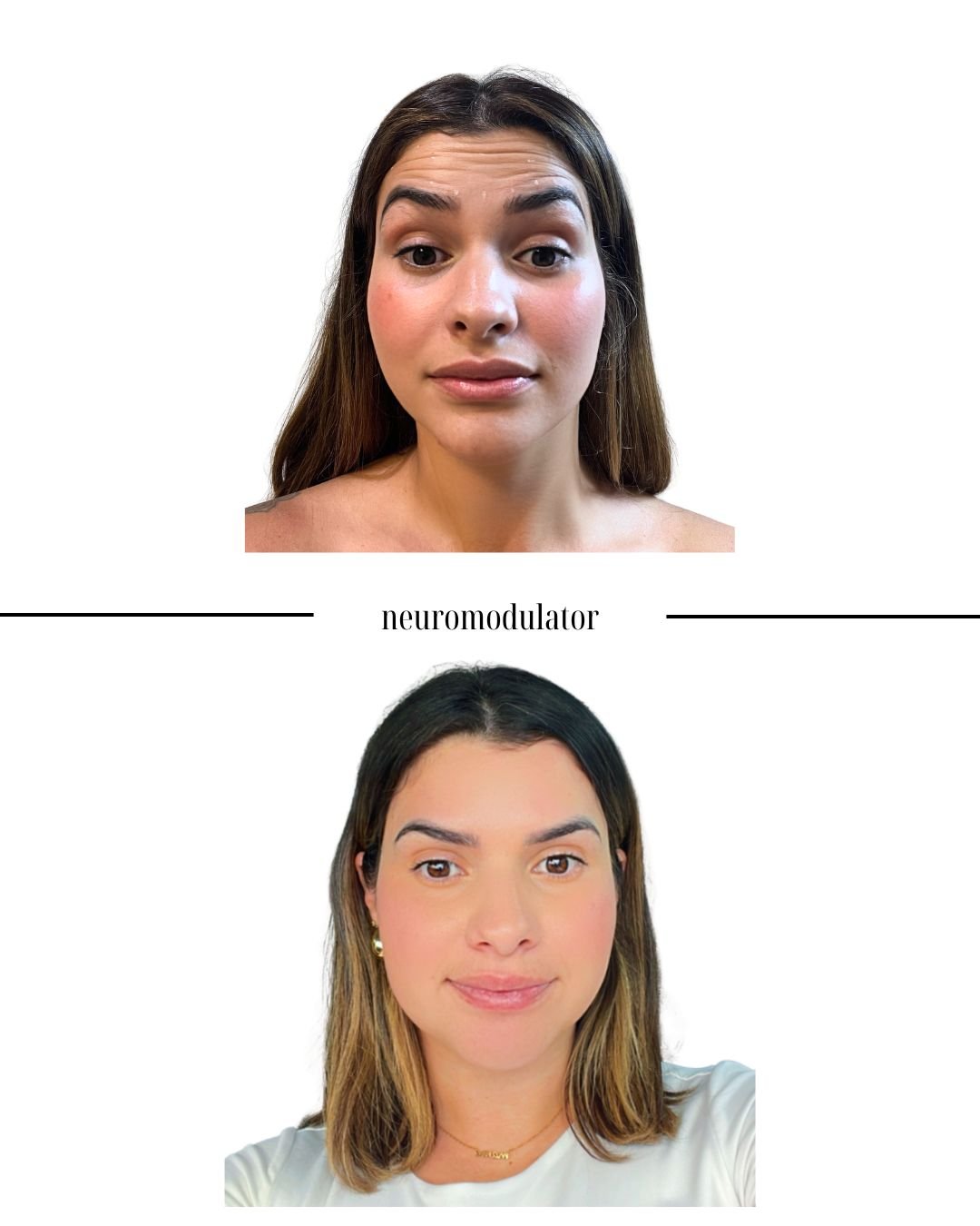Comparison of two women, labeled 'neuromodulator', with different facial expressions and characteristics.