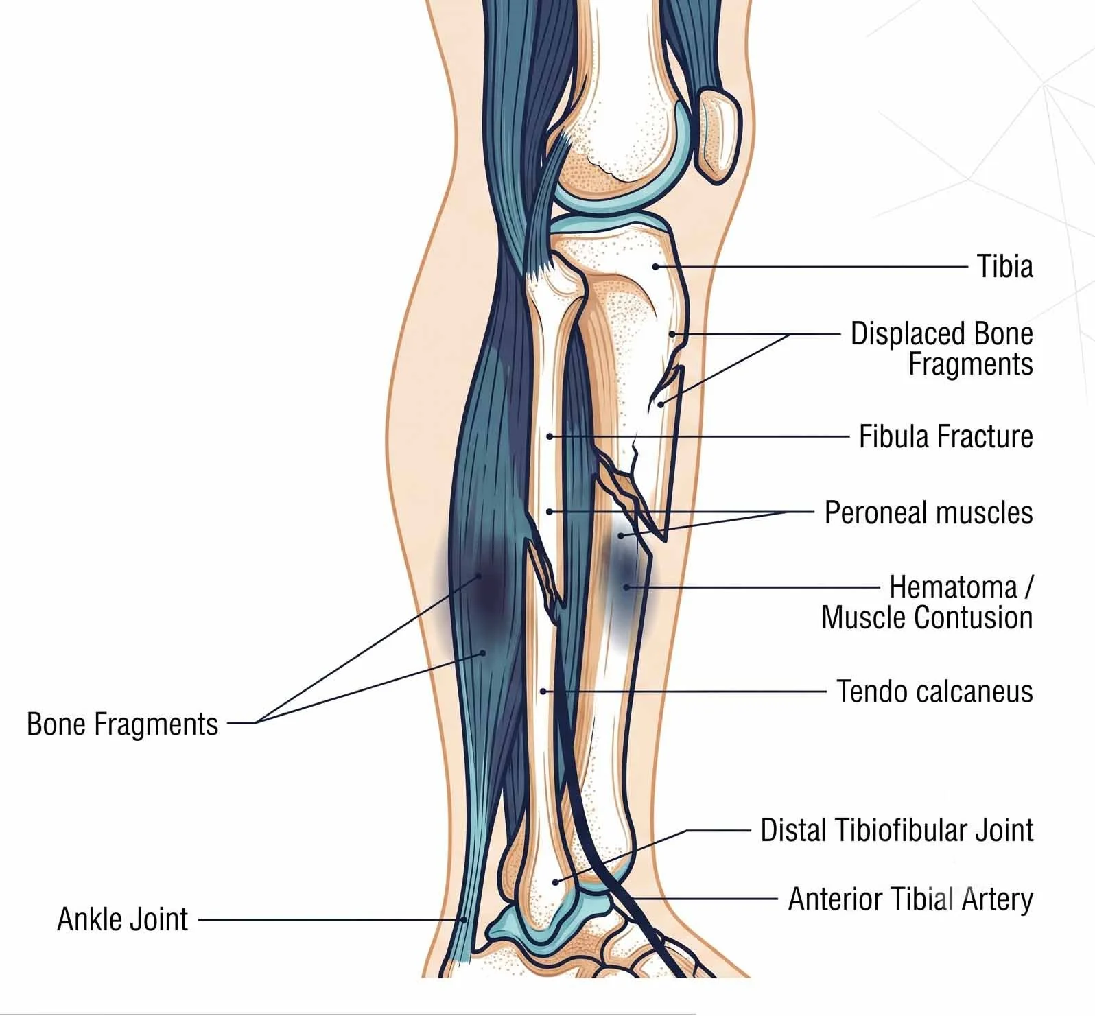 Ilustración anatómica de la rodilla humana mostrando huesos, músculos y lesiones. Incluye etiquetas para la tibia, fragmentos óseos desplazados, fractura en la fíbula, músculos peroneales, hematoma o contusión muscular, tendón calcáneo, articulación distal tibiofibular, arteria tibial anterior y articulación del tobillo.