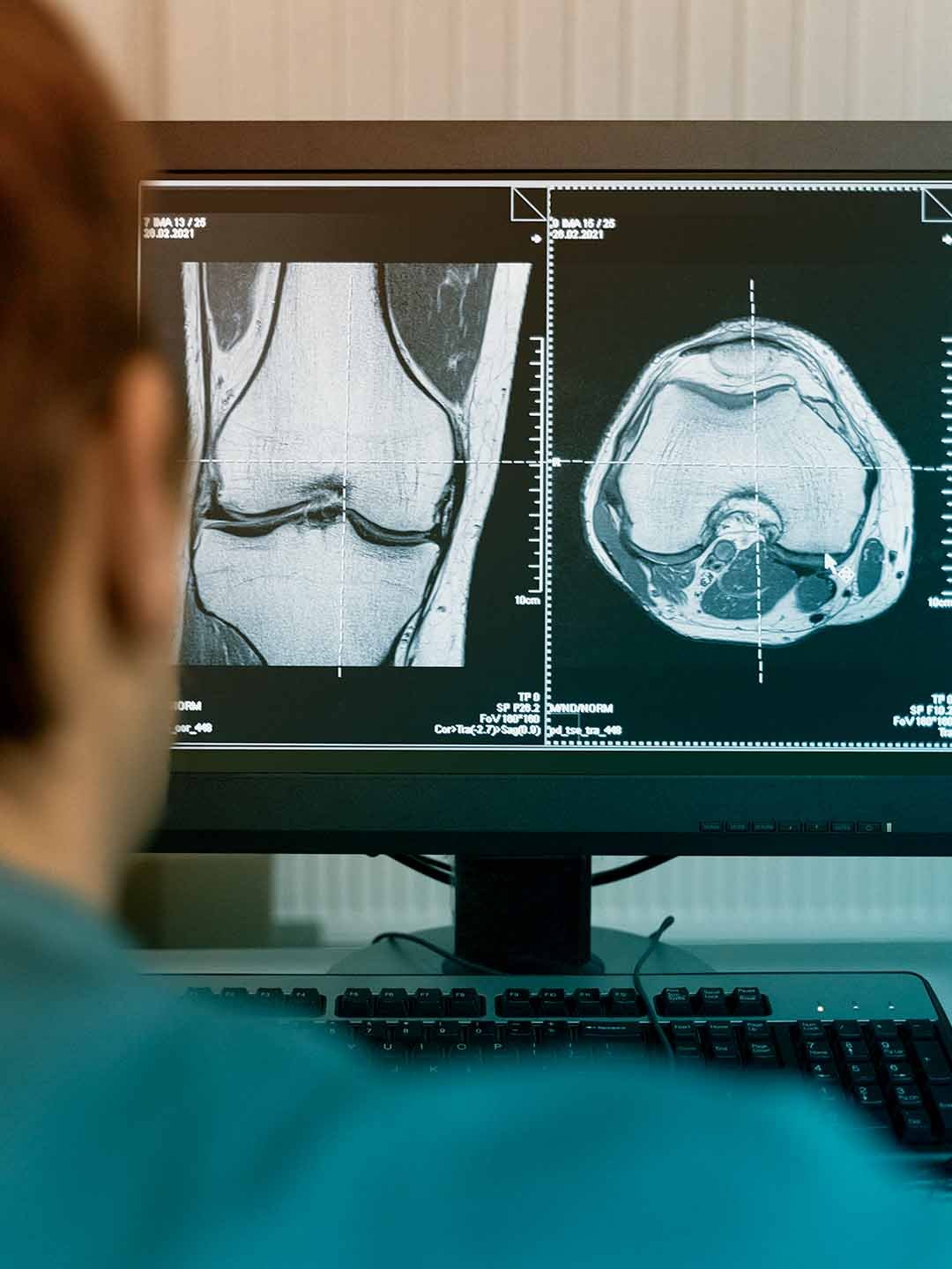 Imágenes de resonancia magnética de una rodilla en la pantalla de una computadora.