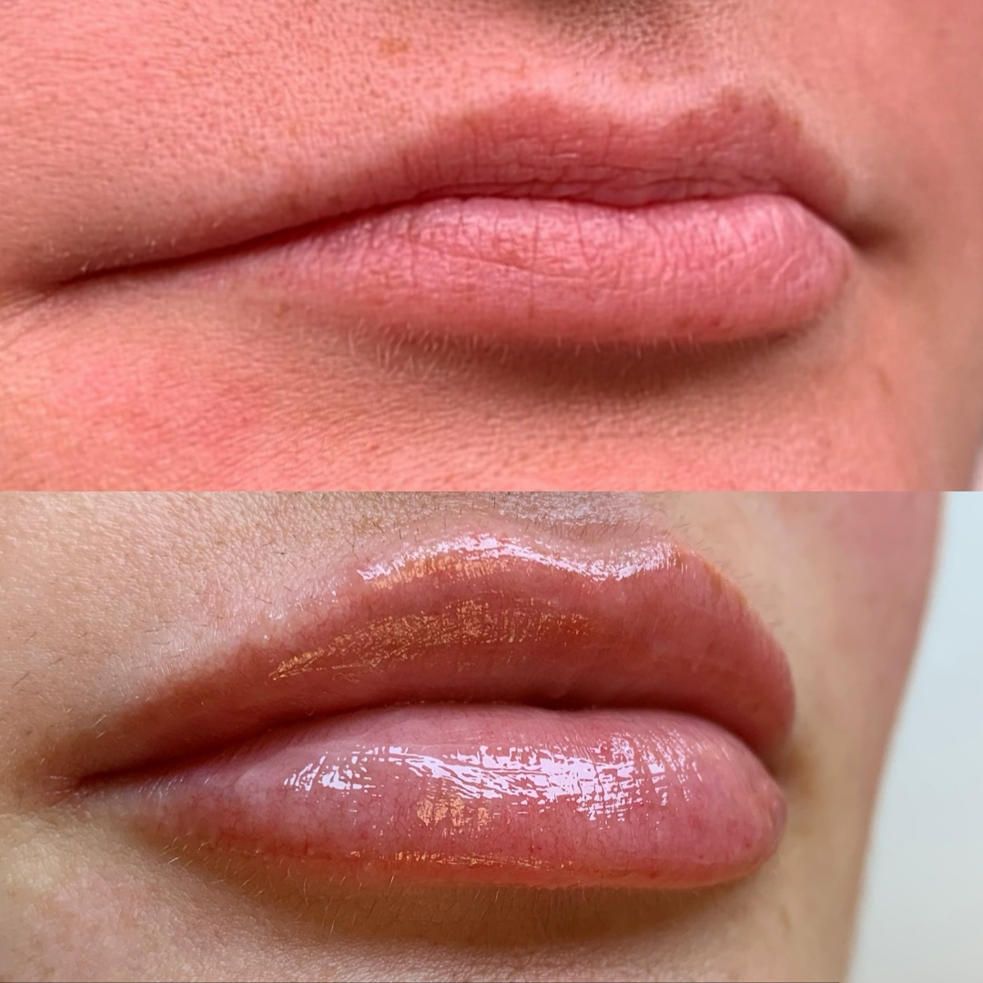 Medspa in Martinsburg, WV 25404 l Fillers Near Me