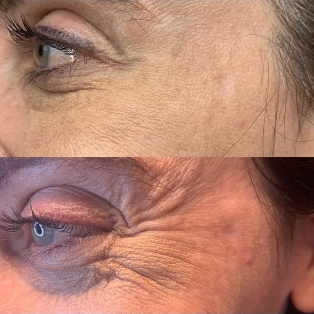 Medspa in Martinsburg, WV 25404 l Botox Near Me