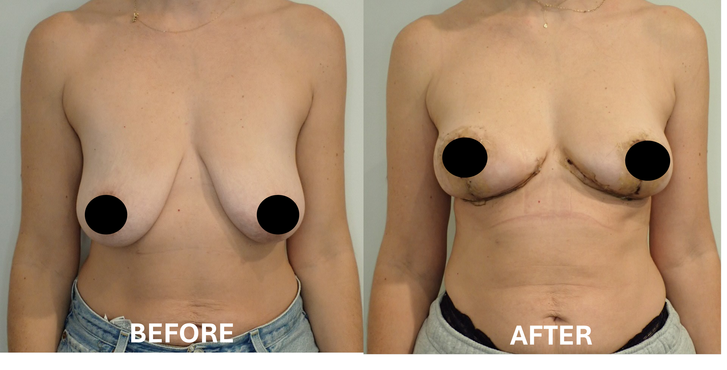 Side-by-side comparison of a woman before and after breast surgery, with black circles covering her nipples, showing her upper body and chest area.