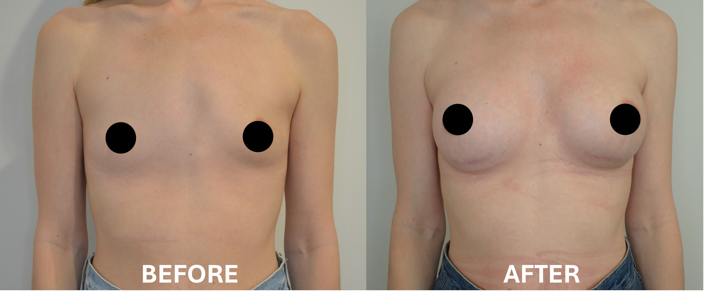 Side-by-side comparison of a woman's chest before and after breast surgery, with the 'before' on the left showing smaller breasts and the 'after' on the right showing larger, fuller breasts.