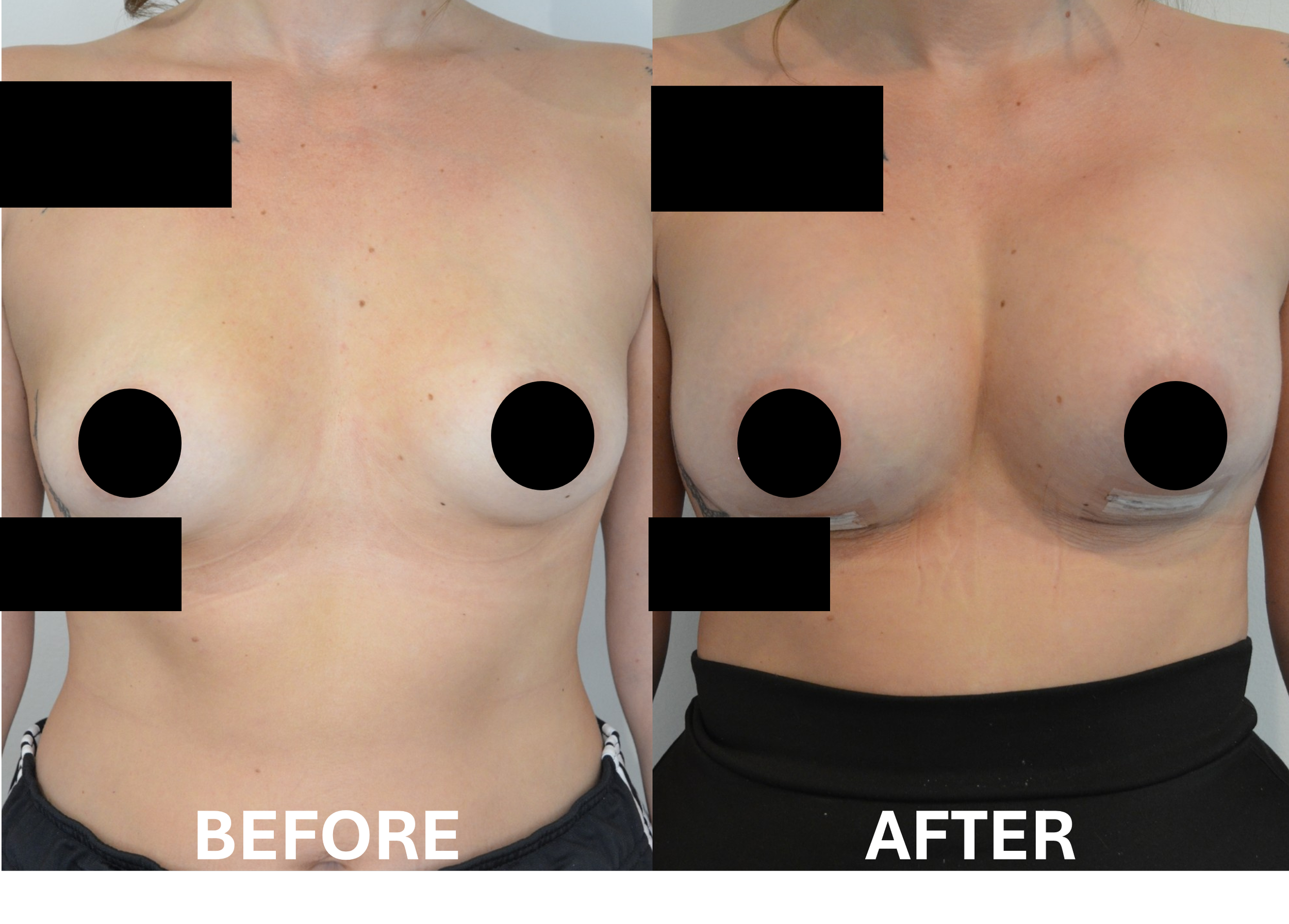 Side-by-side comparison of a woman's chest before and after a cosmetic or medical procedure showing improved skin appearance and contour.