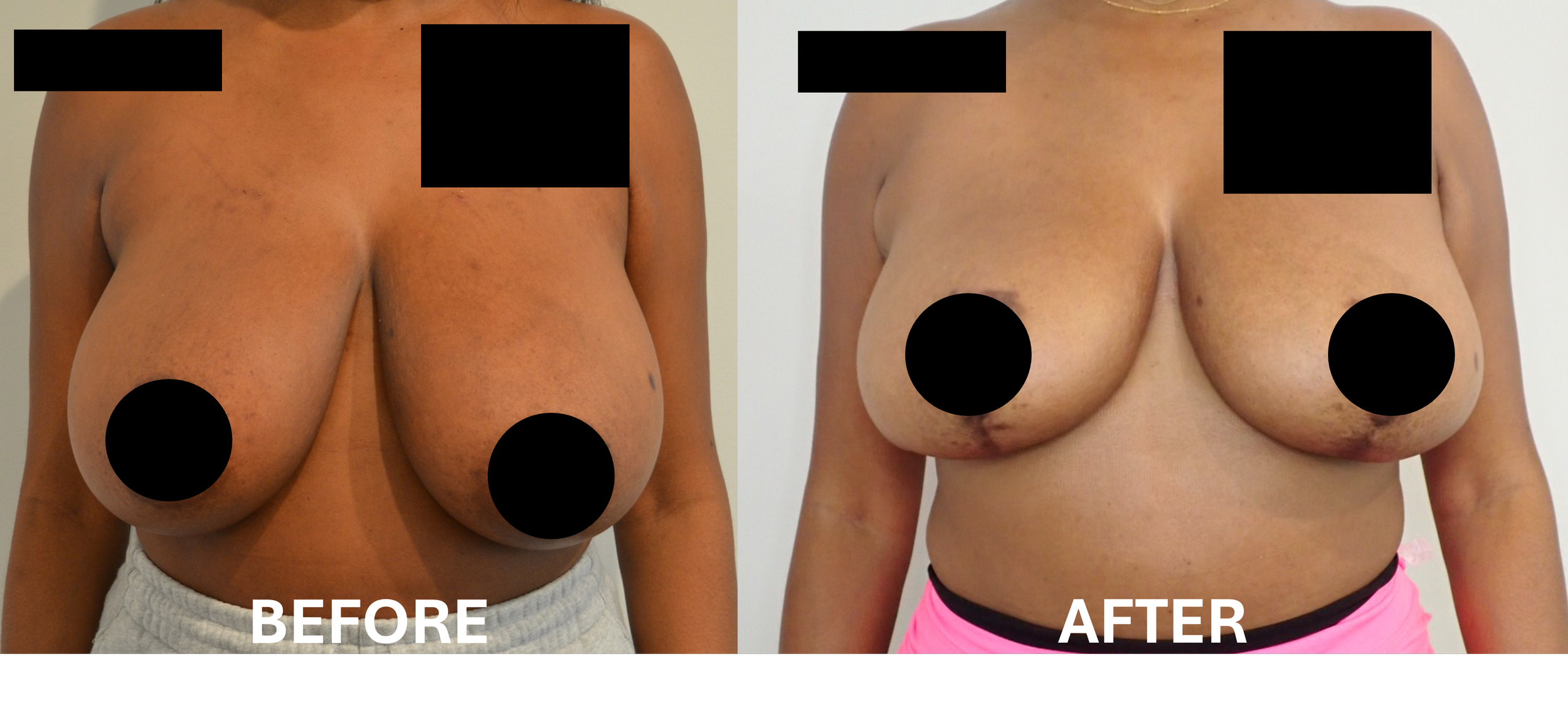 Comparison of a woman's breasts before and after a surgical or cosmetic procedure, showing increased size and changed shape in the after image.