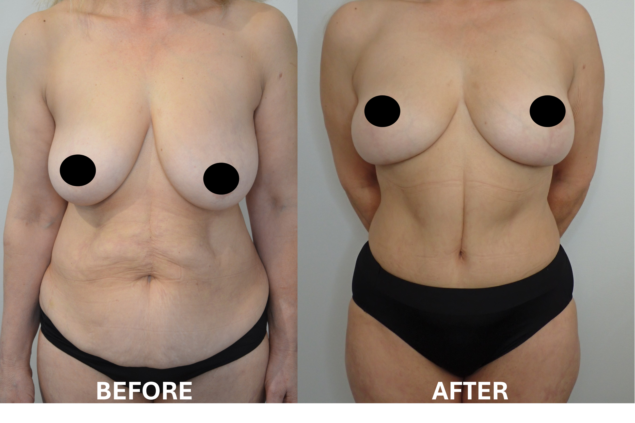 Comparison of a woman's torso before and after breast augmentation, with the "before" showing smaller breasts and the "after" showing larger, fuller breasts.