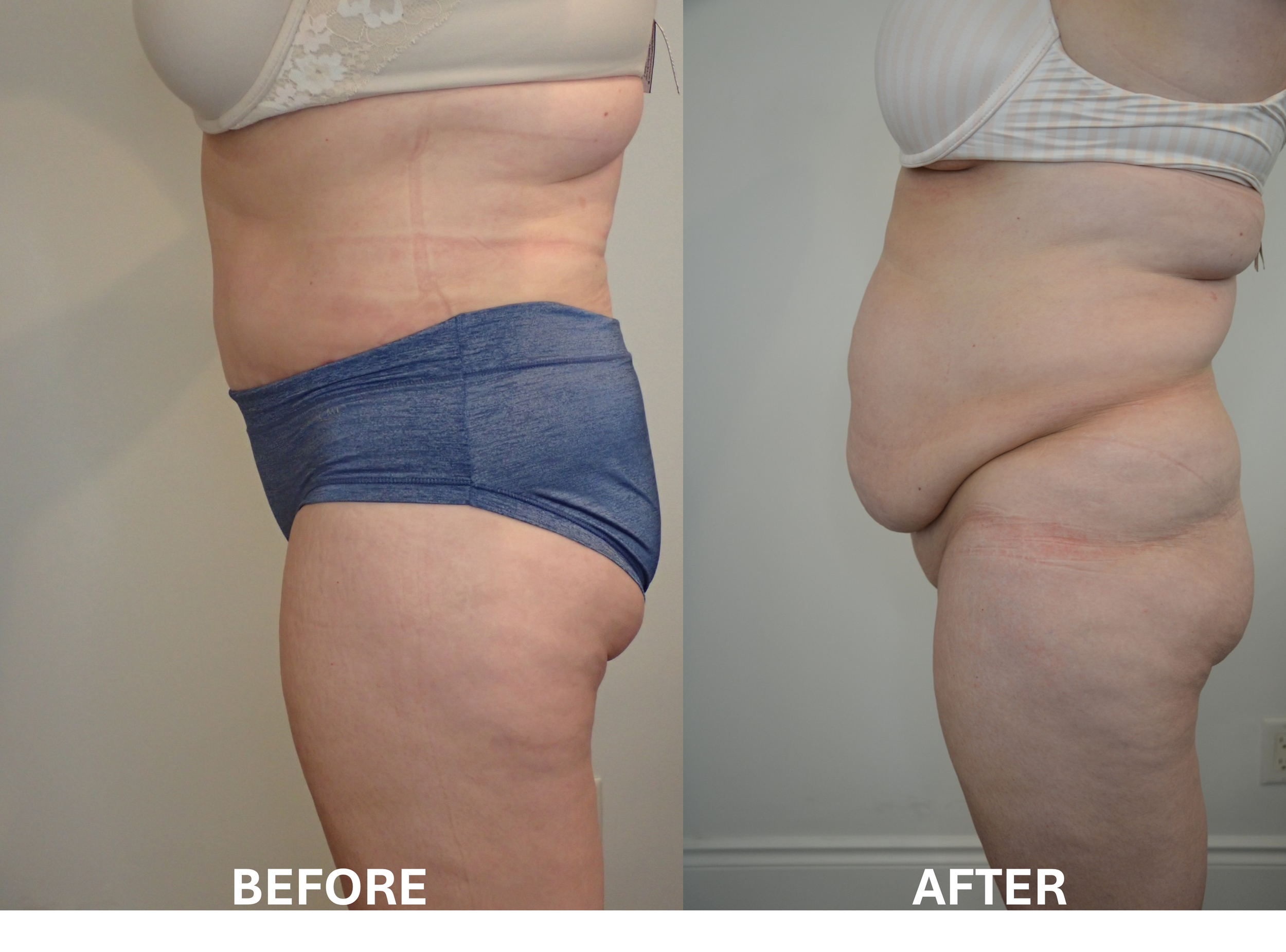 Comparison photo showing the lower torsos of two women. The left side labeled 'Before' shows a woman with loose skin and stretch marks on her stomach, wearing a cream-colored top and dark blue shorts. The right side labeled 'After' shows a woman with less loose skin and stretch marks, wearing a striped top. The background is plain and neutral.