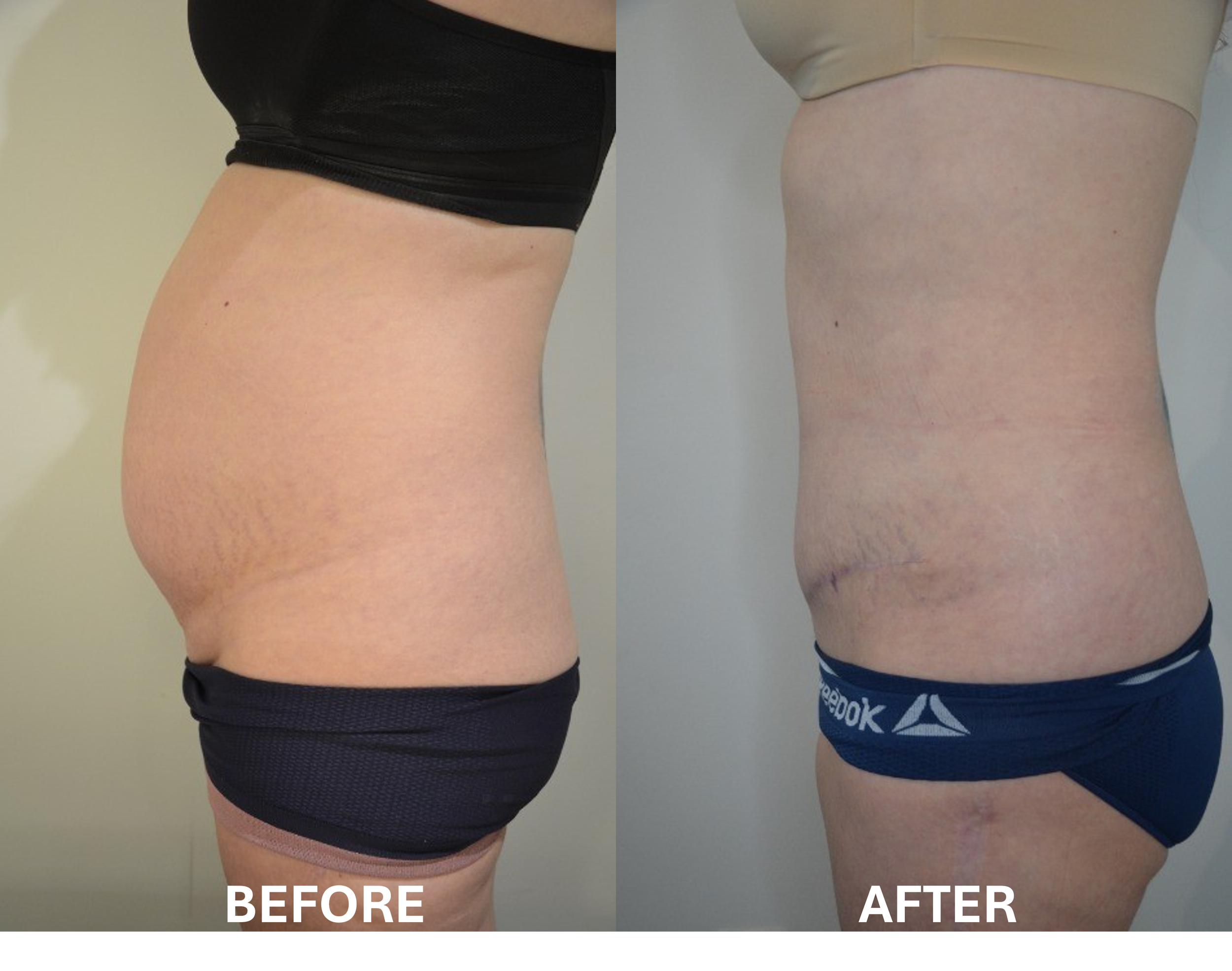 Comparison of a person's waist and hip area before and after a transformation, showing reduced fat and improved body shape.