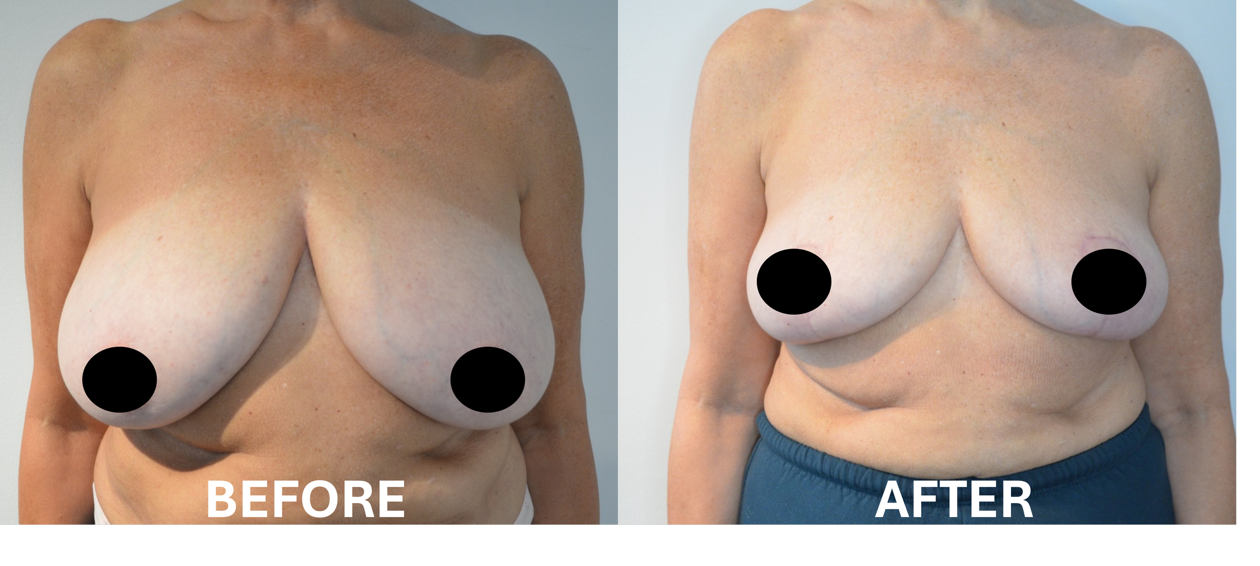 Comparison photo of a woman's chest and torso with 'before' and 'after' labels, showing breast reduction results.