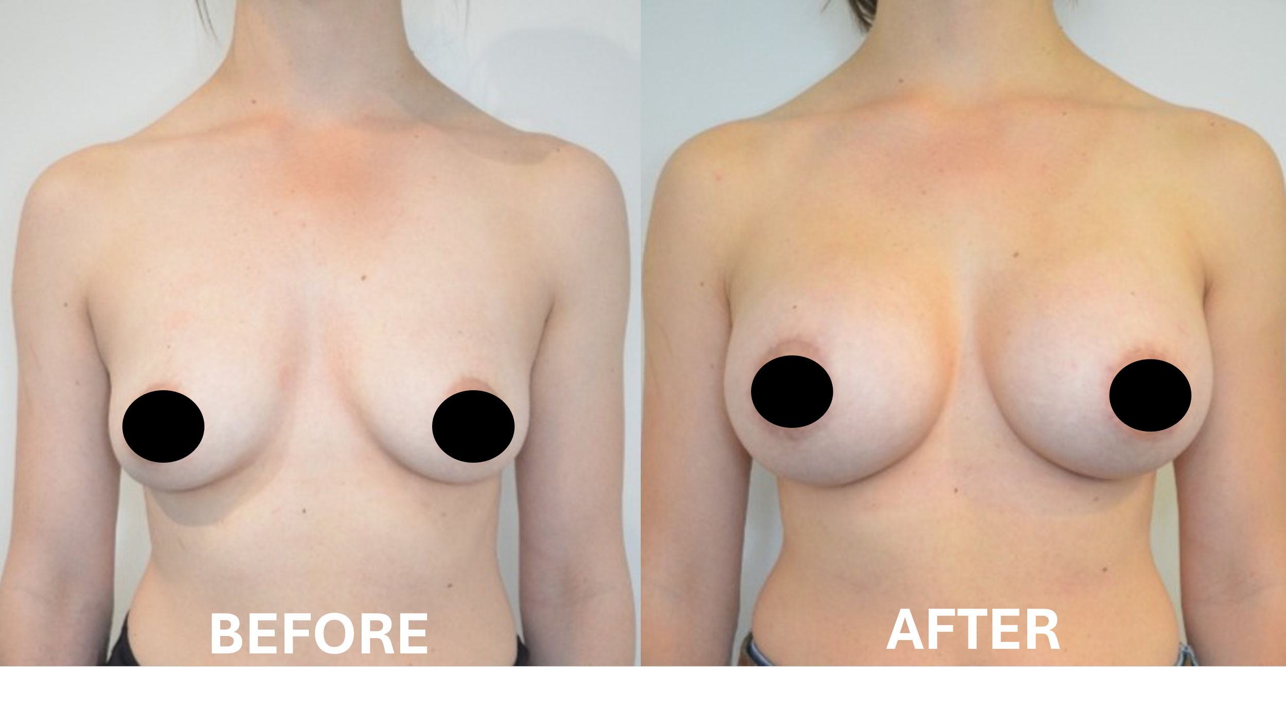 Side-by-side comparison of a woman's chest before and after breast augmentation surgery, with nipples covered by black circles. The left shows the 'before' image with smaller breasts, and the right shows the 'after' image with larger, fuller breasts.