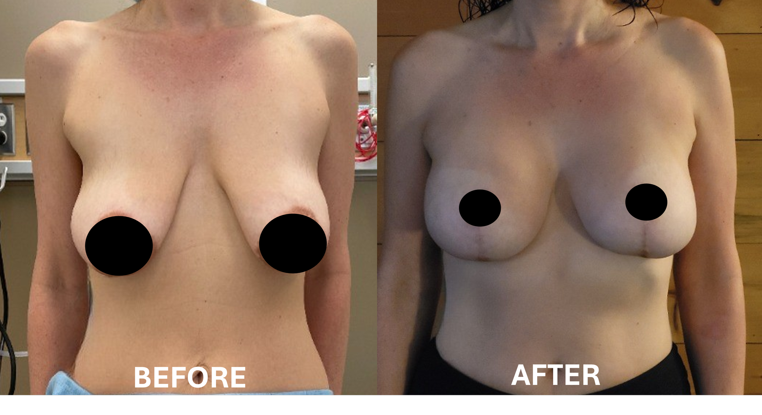 Side-by-side comparison of a woman's upper torso before and after breast augmentation surgery. The left image shows the woman with smaller breasts, and the right image shows her with larger, fuller breasts. The black circles censor her nipples in both images.