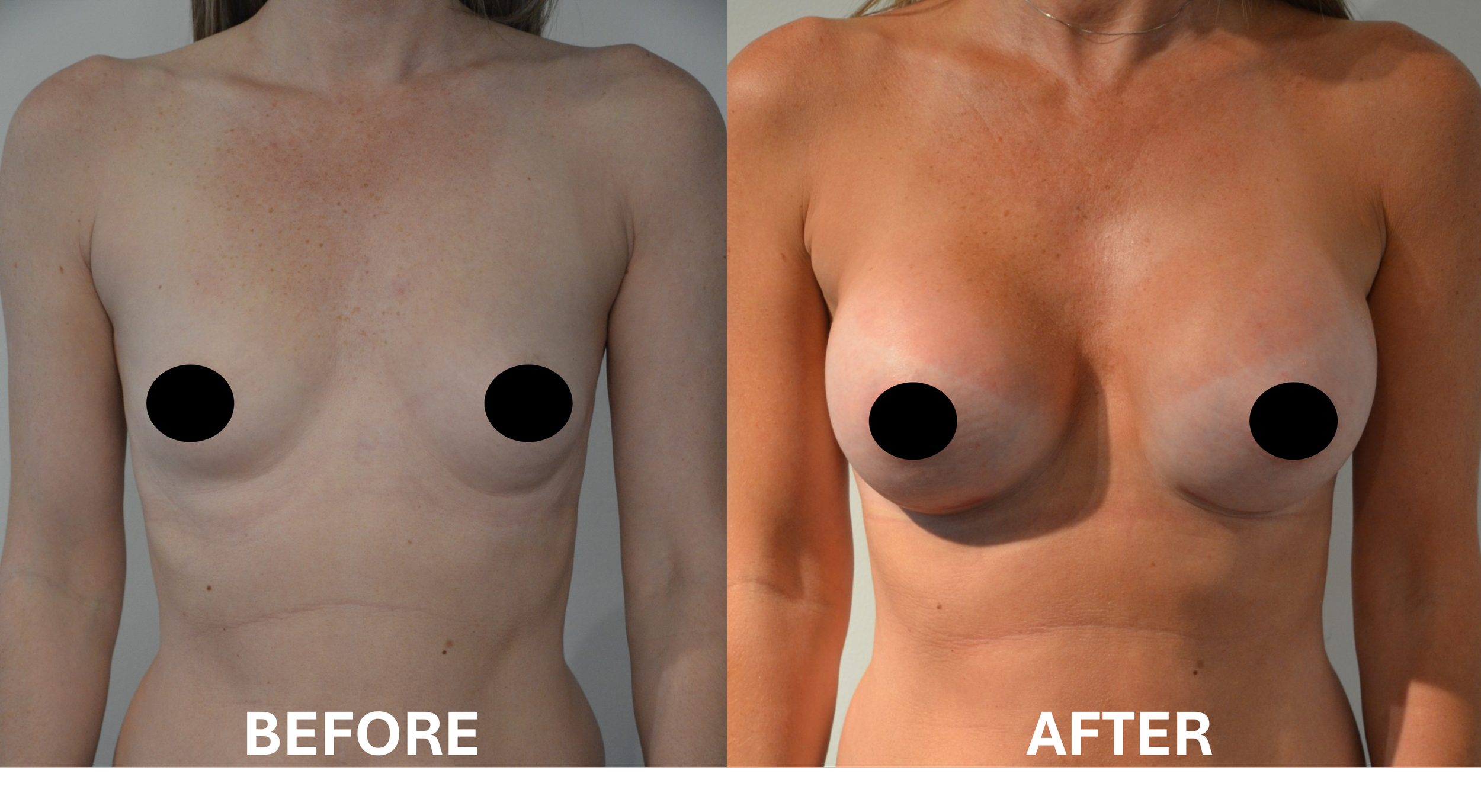A side-by-side comparison of a woman's upper body with the words 'BEFORE' and 'AFTER' printed at the bottom, showing changes in breast size and skin tone.