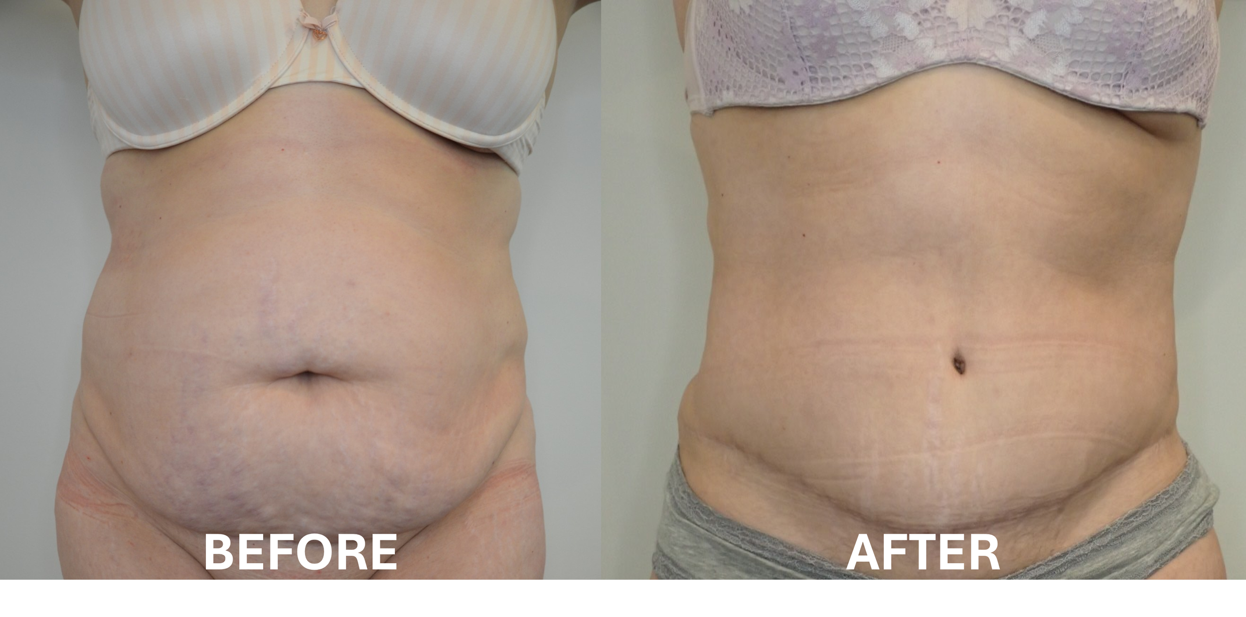 Side-by-side comparison of a woman's abdomen showing visible fat and skin on the left labeled 'BEFORE,' and a more toned and slimmer abdomen on the right labeled 'AFTER.'