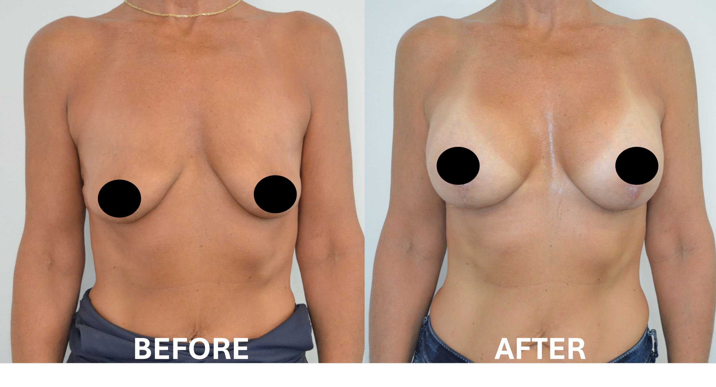 Comparison of a woman's upper body before and after breast augmentation surgery, showing changes in breast size and shape.