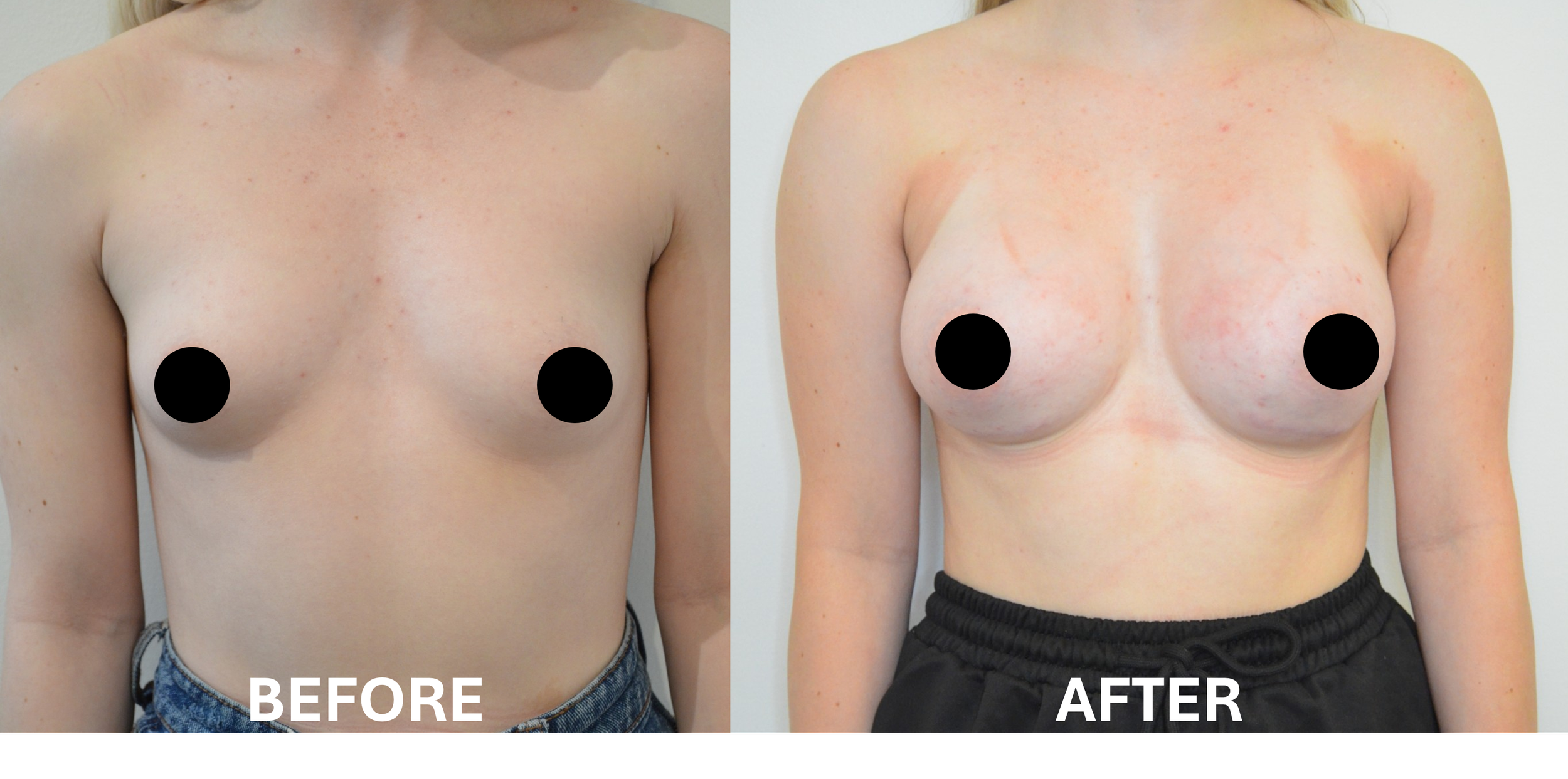 Side-by-side comparison of a woman's chest before and after breast augmentation, with black circles covering the nipples, labeled 'Before' on the left and 'After' on the right.