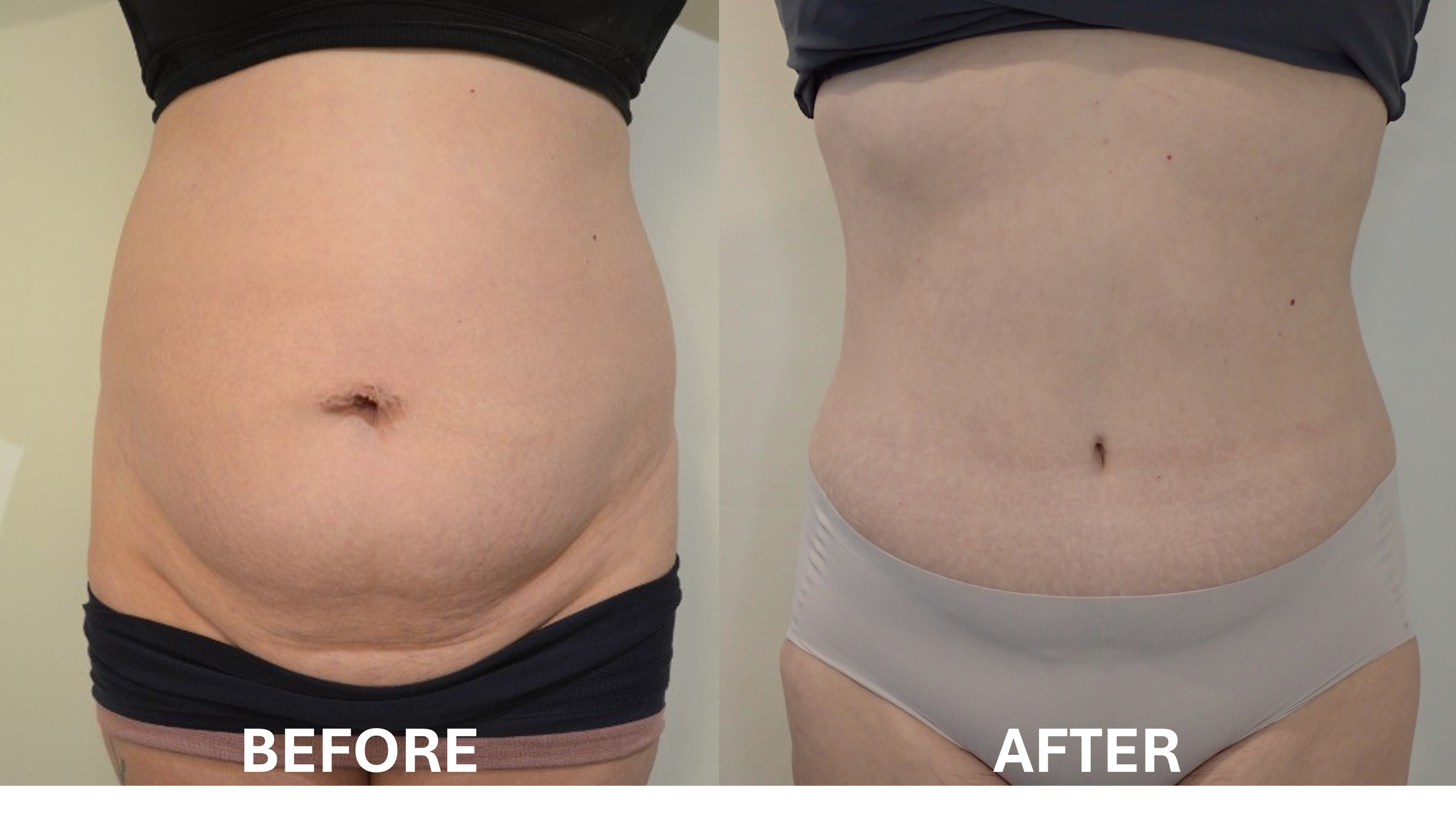 Side-by-side comparison of a woman's abdomen showing before and after weight loss or body contouring. The 'before' image shows a larger, more rounded abdomen, while the 'after' image shows a flatter, more toned abdomen.
