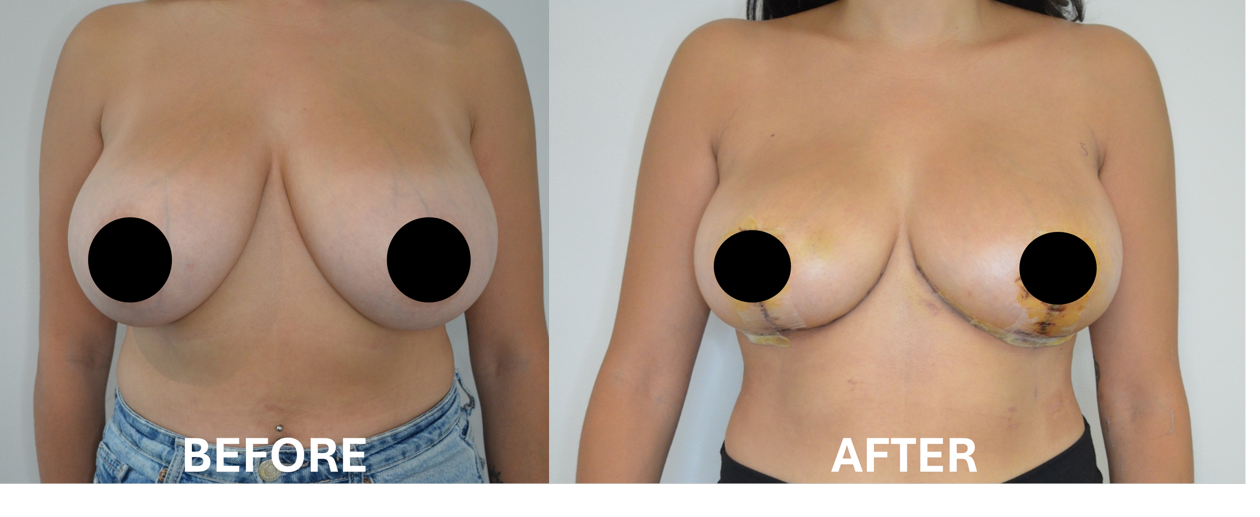 Side-by-side comparison of a woman's torso before and after breast surgery, with black circles censoring her nipples. The left shows her natural breasts, and the right shows her post-surgical results with visible markings.