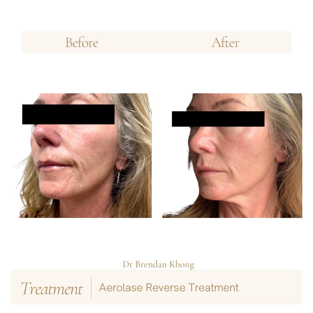 before after for reverse 01.JPG
