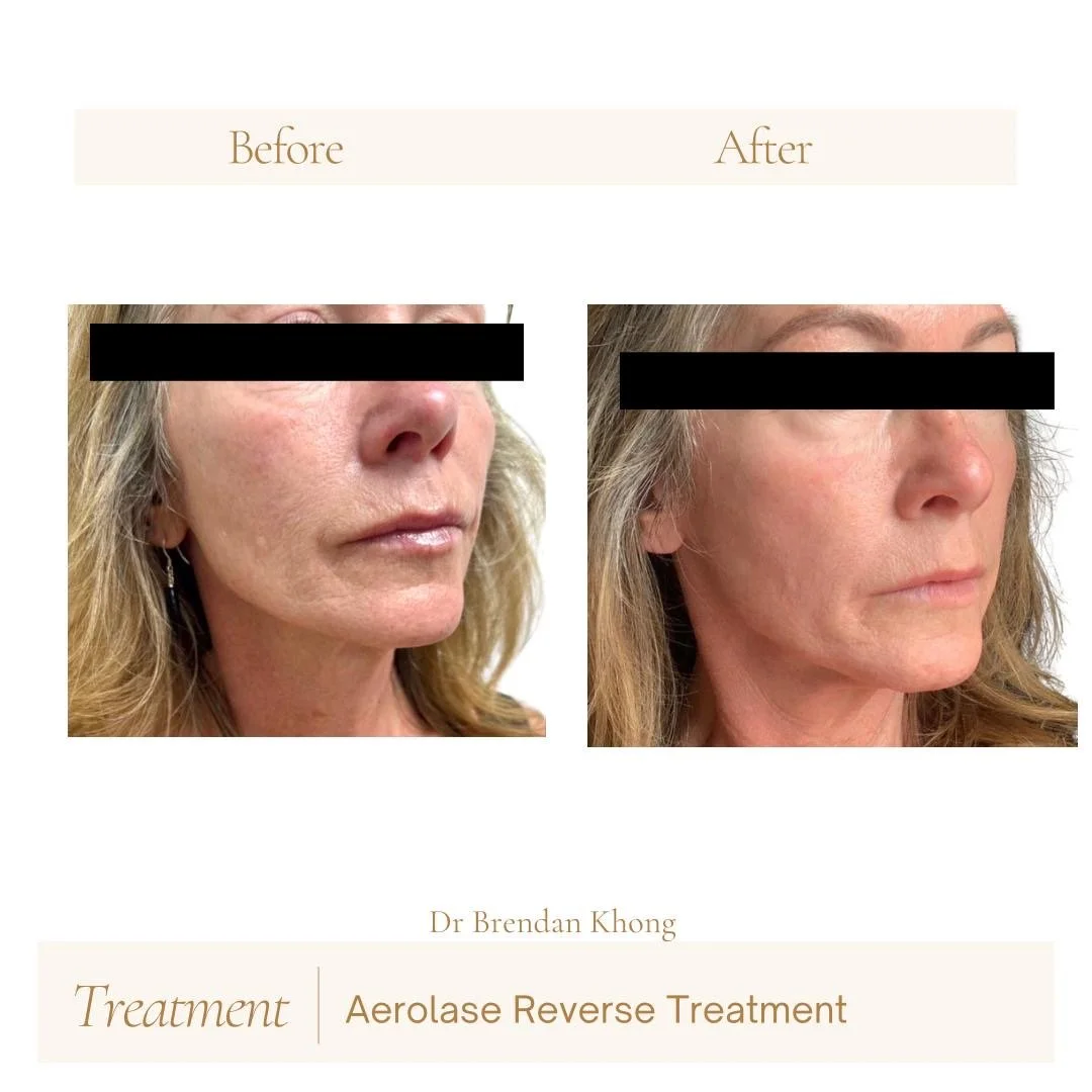 before after for reverse 03.JPG