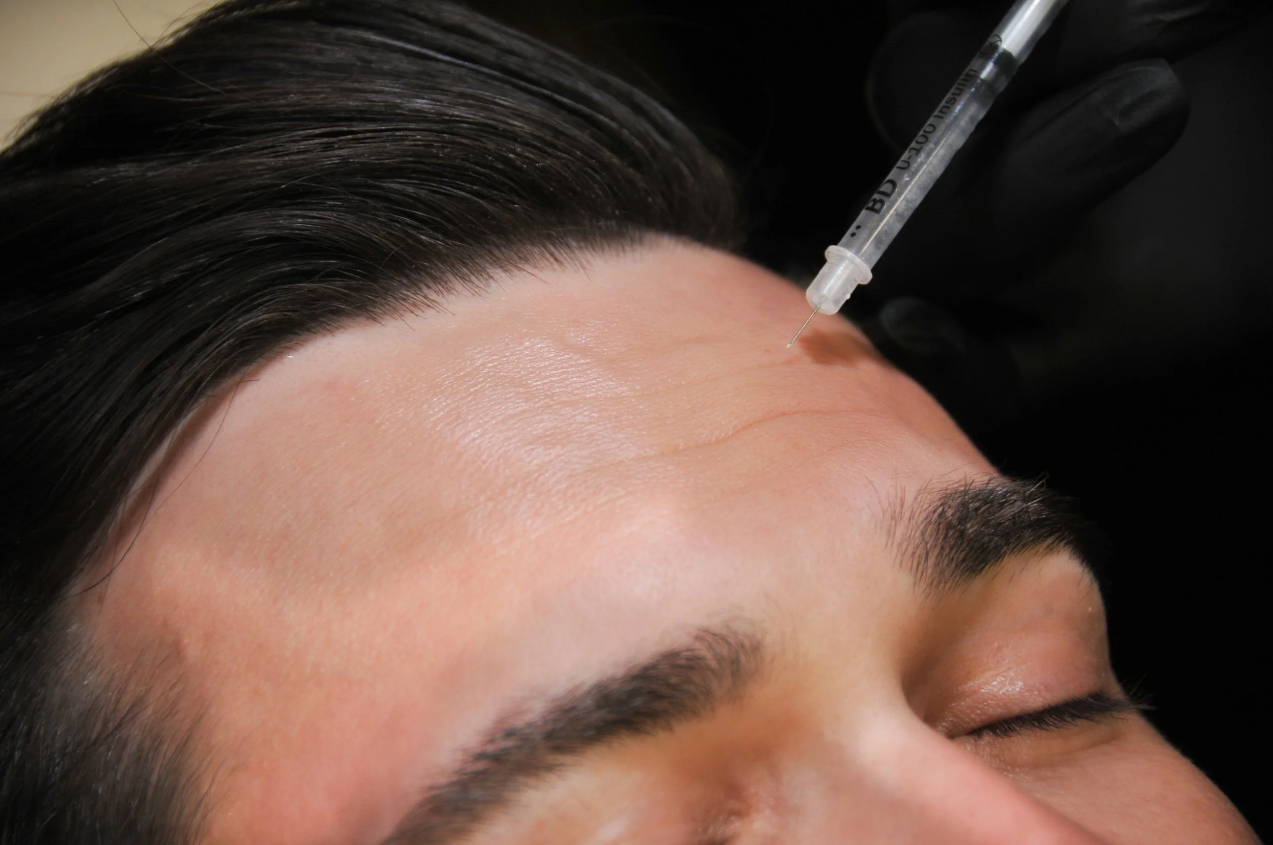 Anti-Wrinkle Treatments London